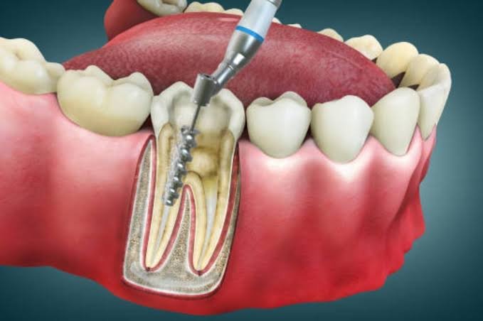 Long-term Benefits of Timely Root Canal Therapy
