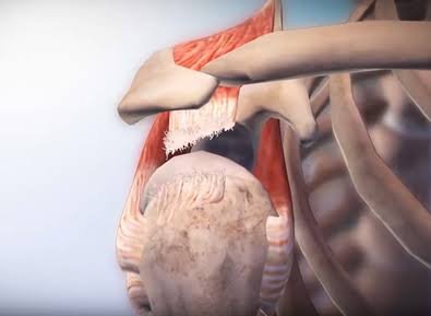 Signs You Might Have a Rotator Cuff Tear and What To Do Next