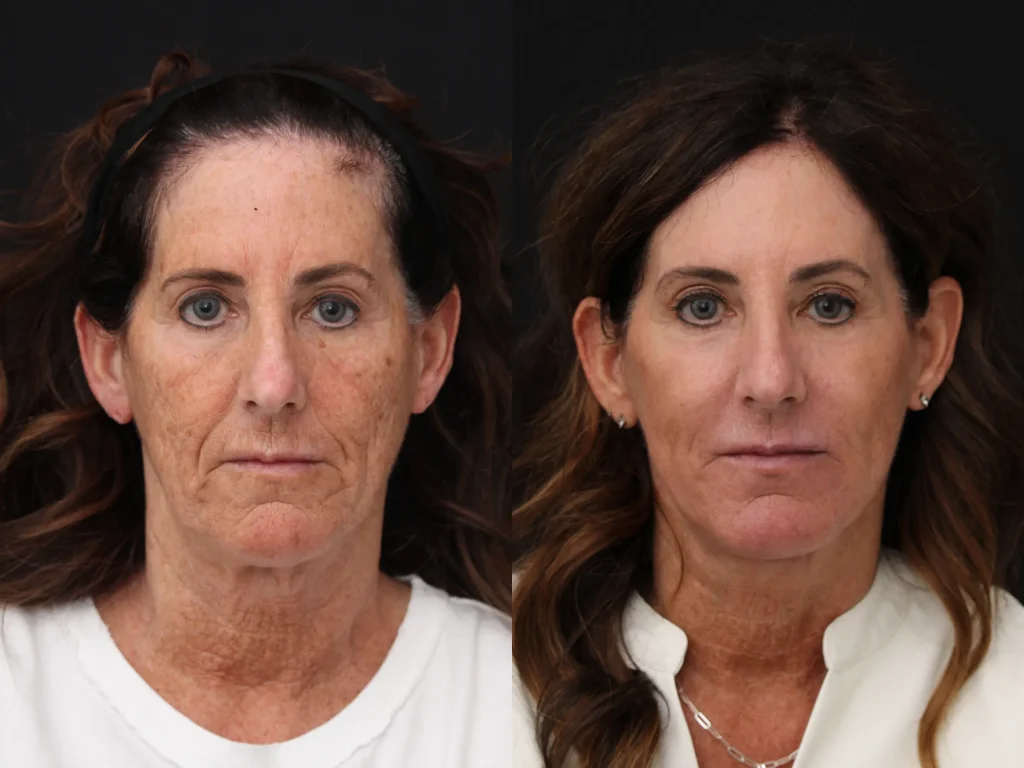 Understanding the Benefits of Mohs Surgery